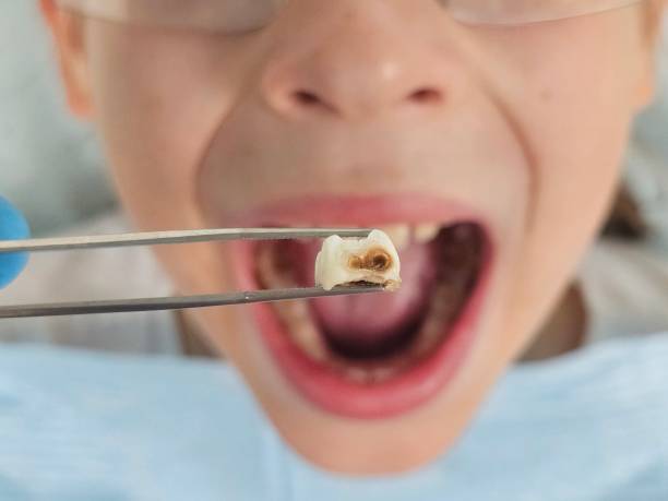 Best Knocked-Out Tooth Emergency  in Calvert, TX
